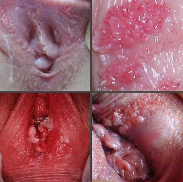 Close de papilomas na vagina