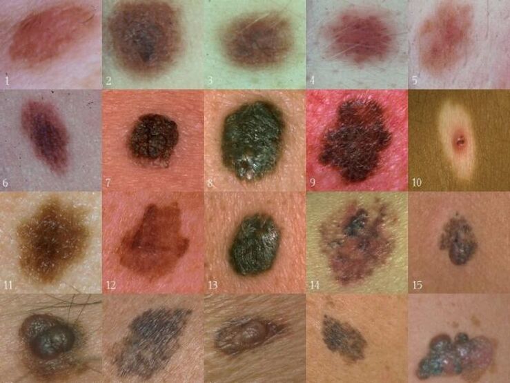 Tipos de verrugas na pele