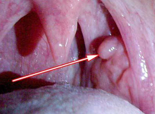 Papiloma na laringe