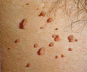 Papilomavírus humano na pele