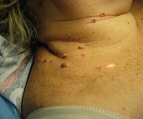 Papilomavírus humano no pescoço