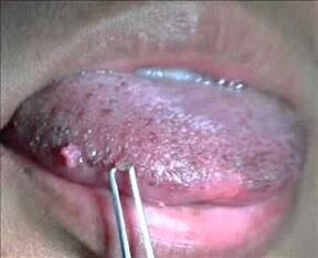 papilomavírus humano na língua