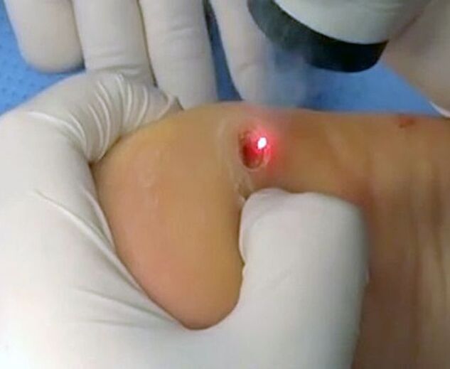 O procedimento para remover verrugas no calcanhar com laser