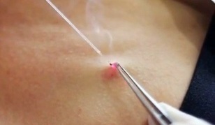 Remoção de papilomas no corpo com laser