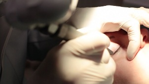 Remoção a laser de papilomas na pálpebra